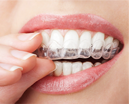 invisalign-side-img